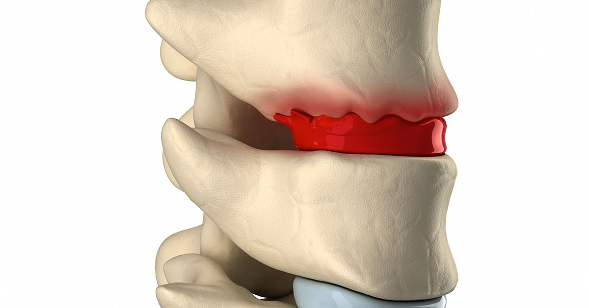 Thoái hóa đĩa đệm gây đau đau xương cột sống lưng dưới
